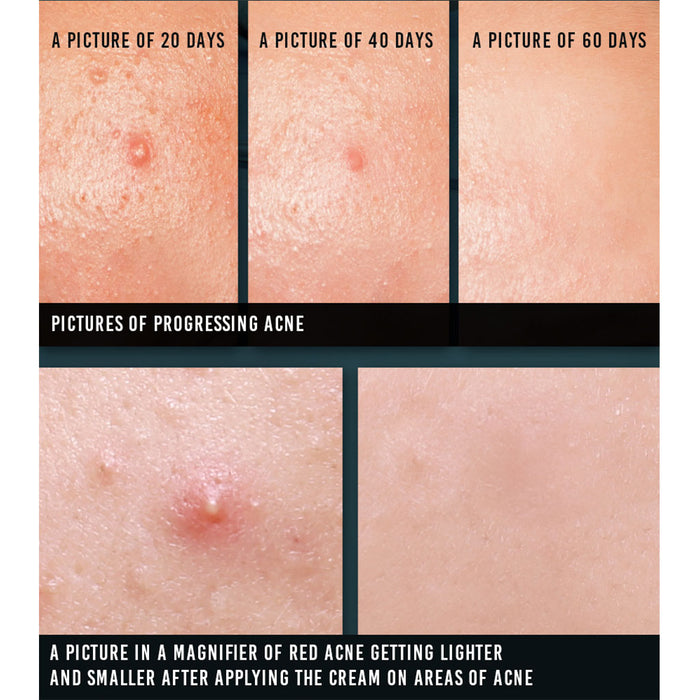 Pyunkang Yul Acne Spot Cream Nudie Glow Korean Skin Care Australia Review Before After Result