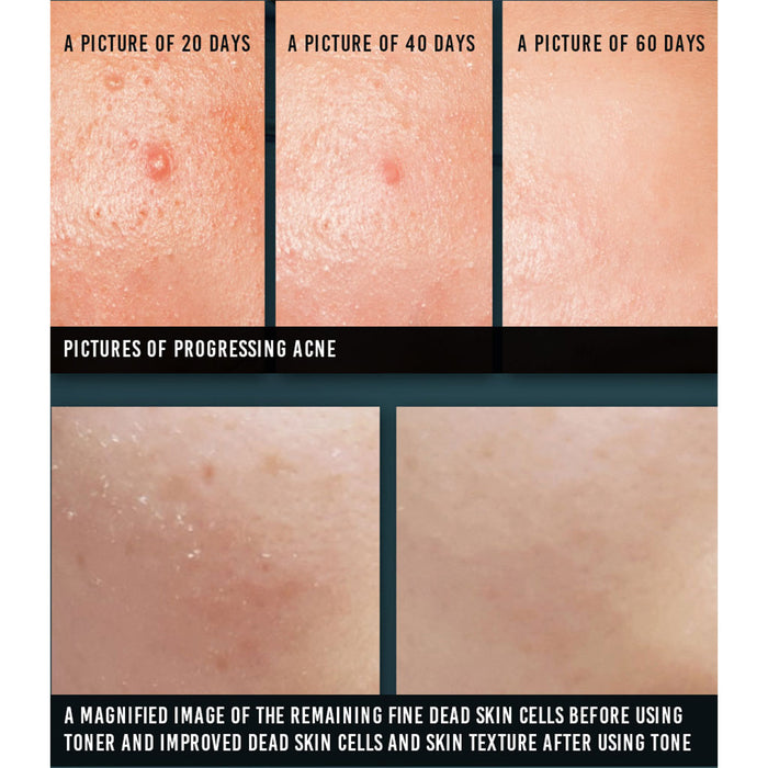 Pyunkang Yul Acne Toner Nudie Glow Korean Skin Care Australia Review Result Before After