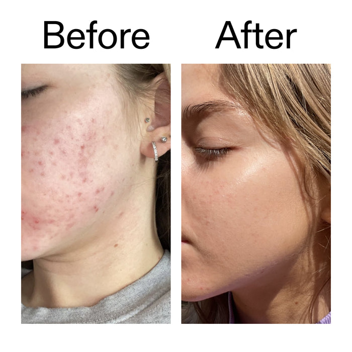 Before and after comparison of a person's face with acne on the left and clear skin on the right.