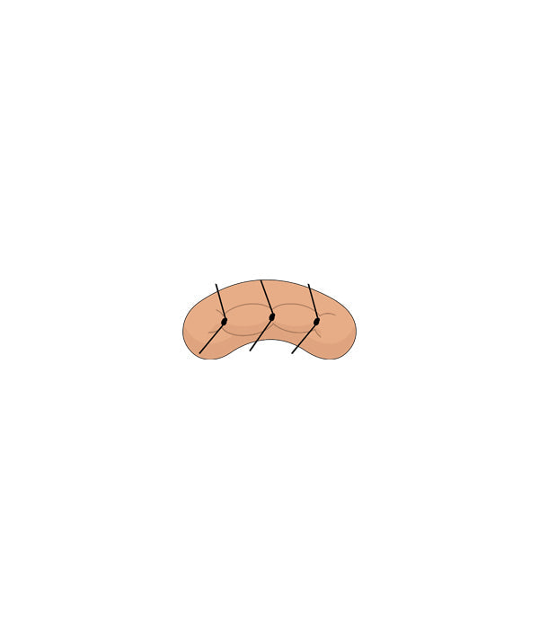 Micro Suture 3 Stitch