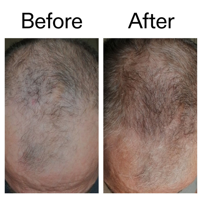 Before and after of customer using Caffeine Scalp Treatment