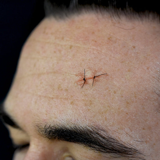 Sutured Wound 2 Stitch